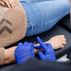 patient receiving acupuncture treatment